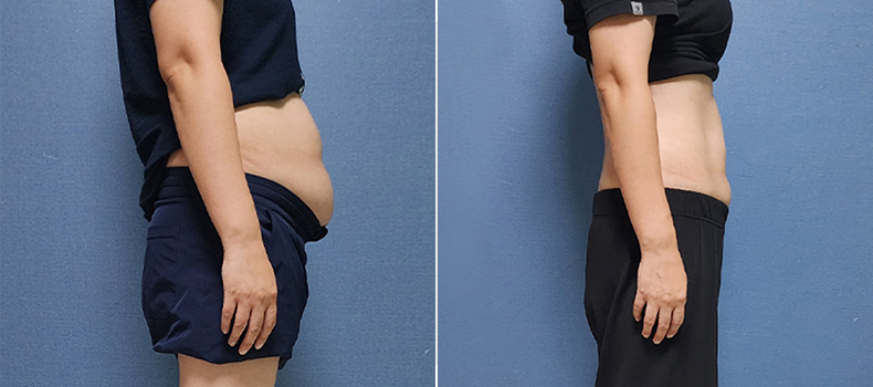 후 치료 케이스