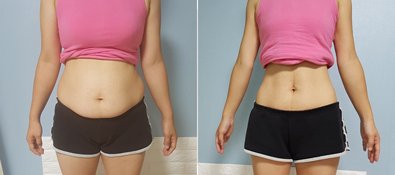 후 치료 케이스