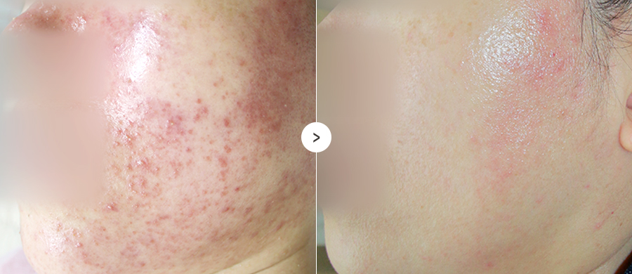 지루성피부염 전후사진